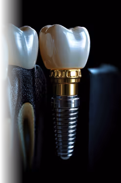 primer kako izgleda implant zuba u vilici